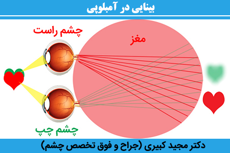 بینایی-در-آمبلوپی
