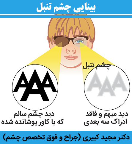 بینایی-چشم-تنبل